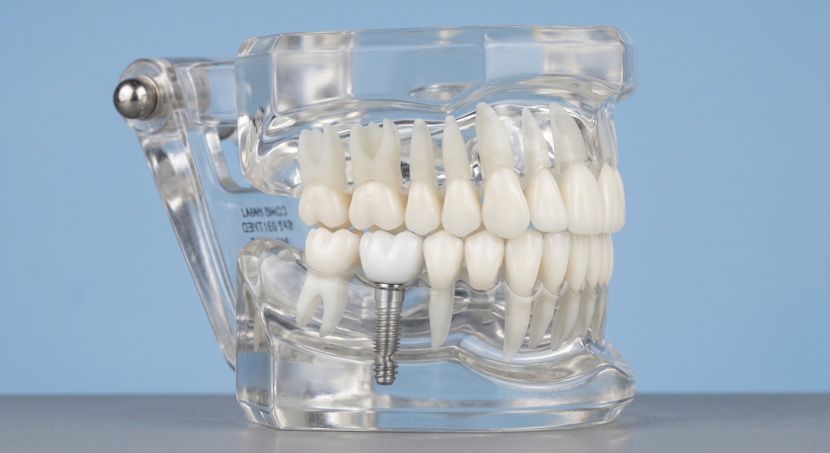 Implants Dentaires